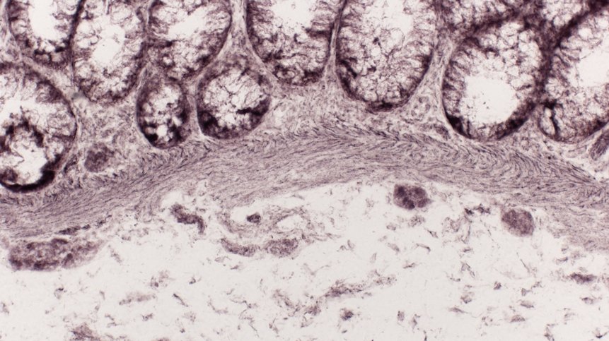 Hirschsprung's Disease