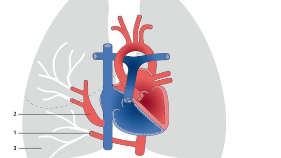 Congenital Heart Disease