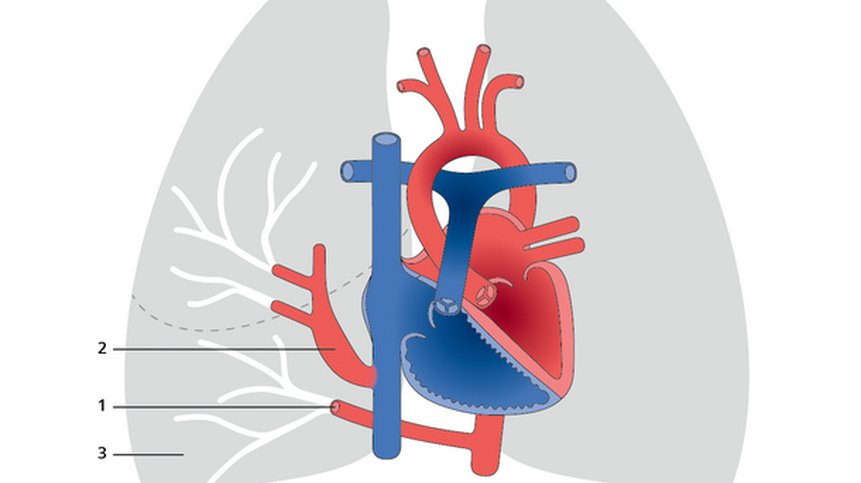 Congenital Heart Disease